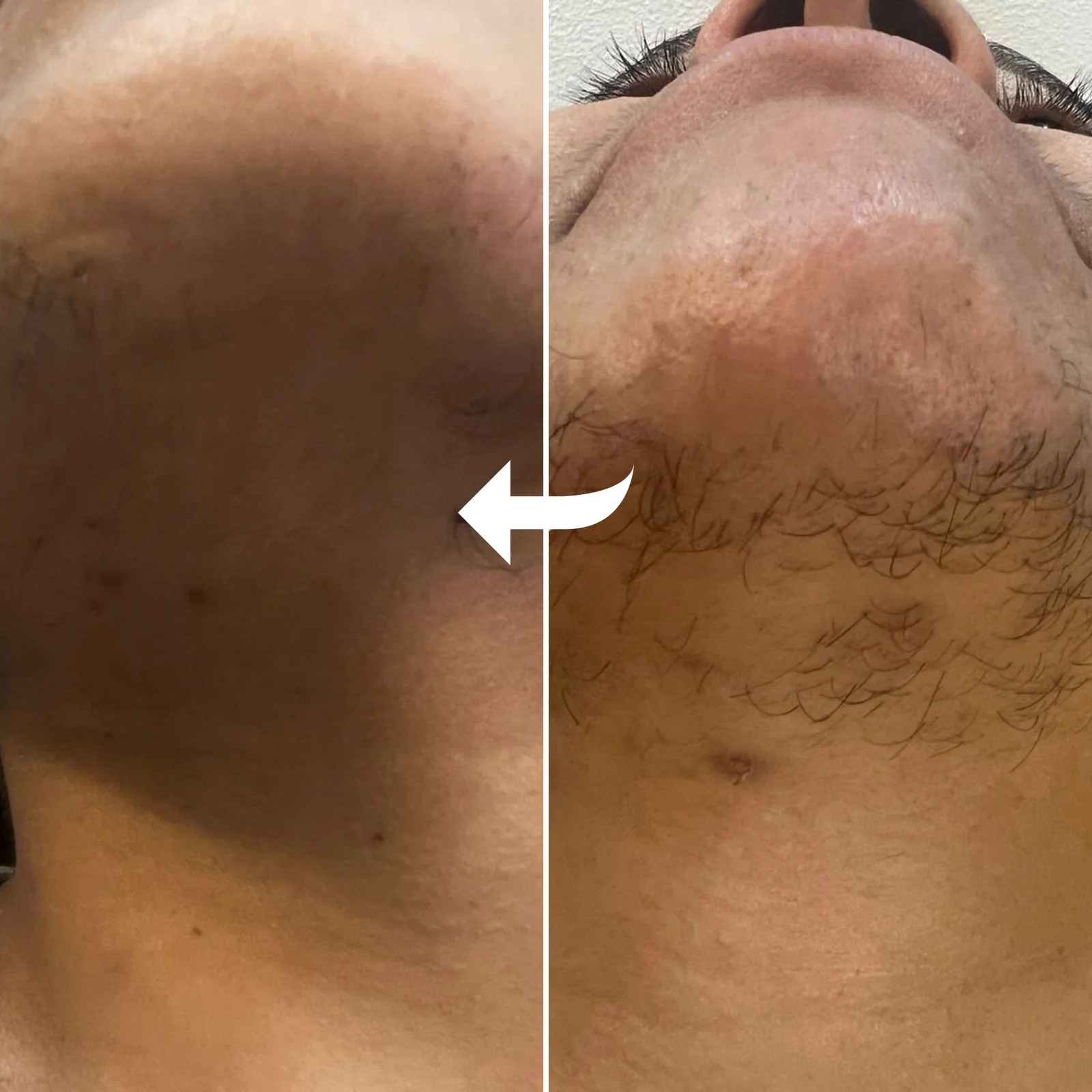 Laser hair removal in jaipur