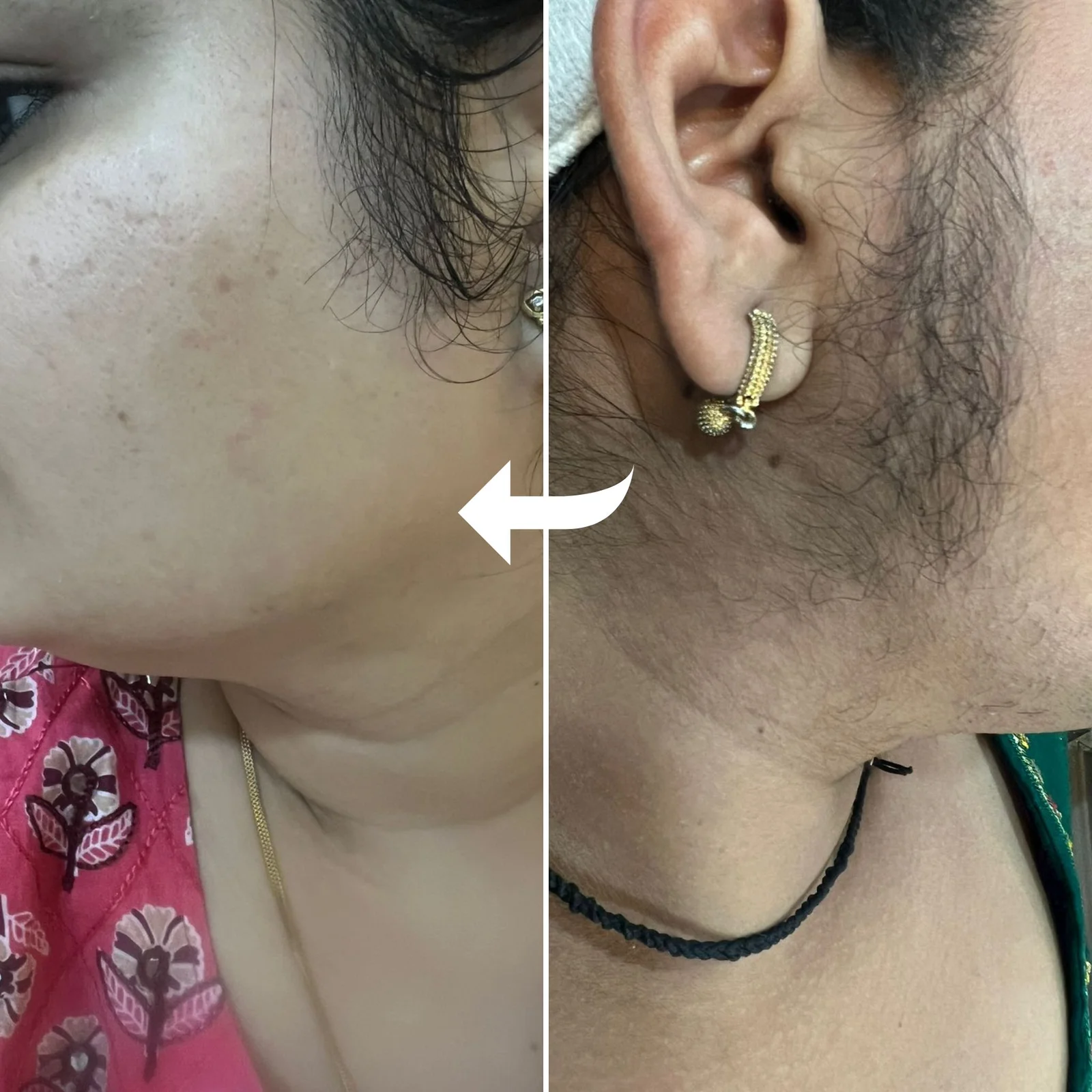 Laser hair removal in jaipur
